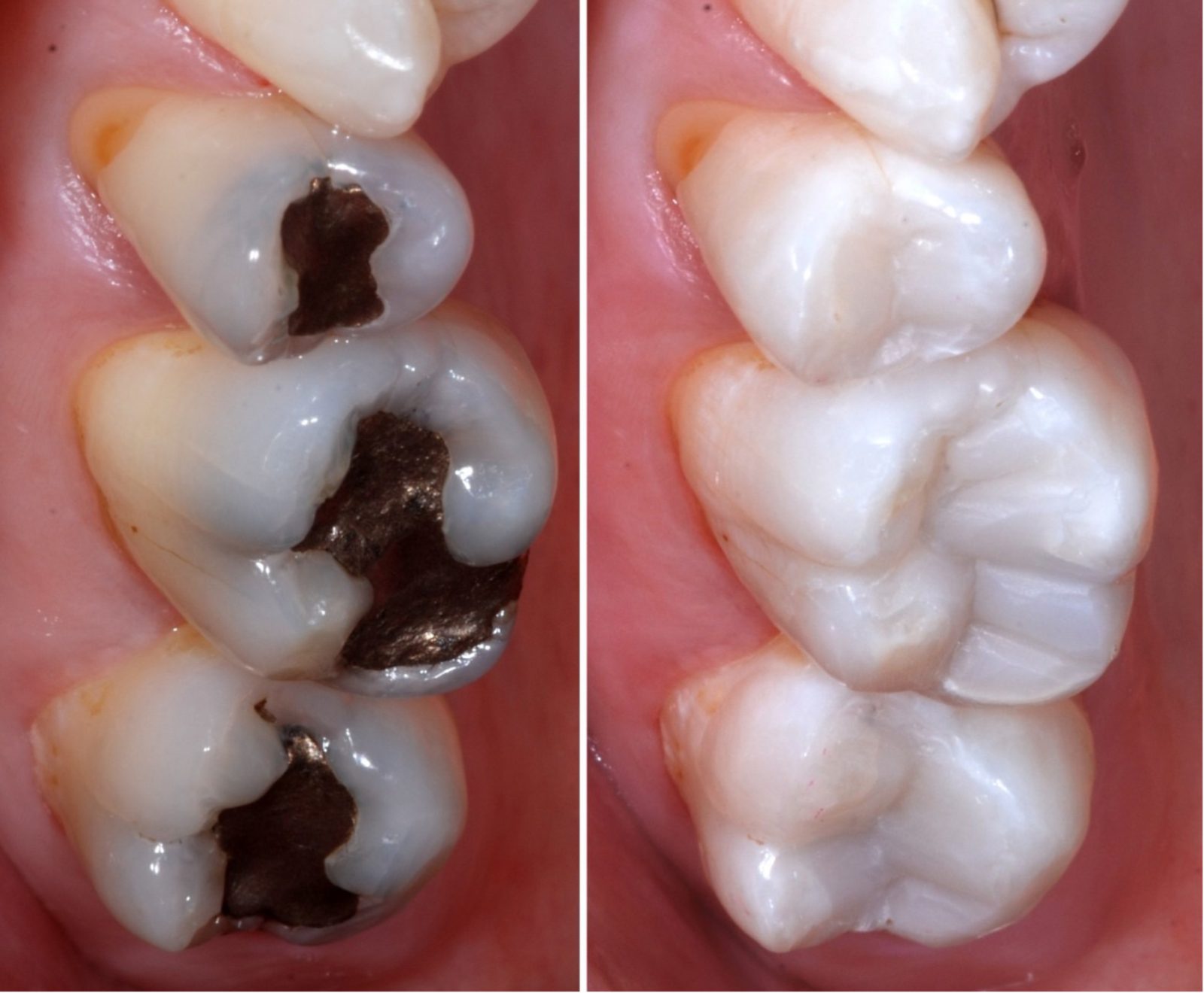 Posterior Composite Restoration